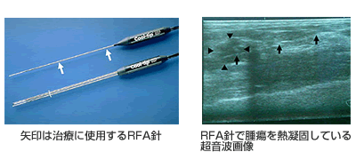 治療に使用するRFA針