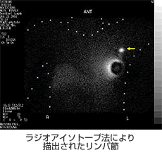 ラジオアイソトープ法により抽出されたリンパ節