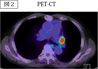 PET-CT