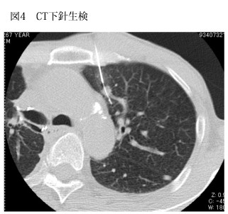 CT下針生検