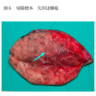 切除標本 矢印は腫瘍