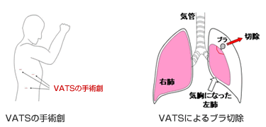 VATS (胸腔鏡下)ブラ切除術