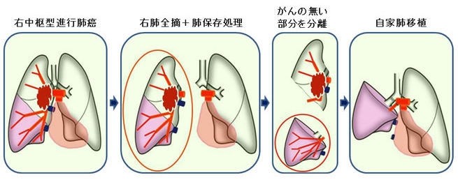 自家肺移植の様子