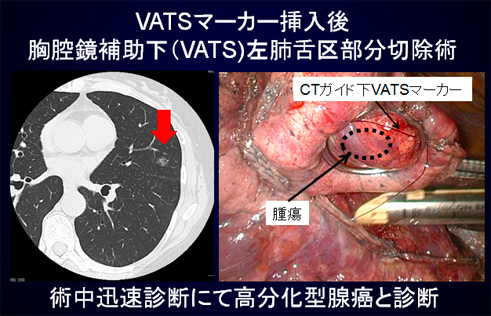 VATSマーカー挿入後 胸腔鏡補助下（VATS）左肺舌区部分切除術