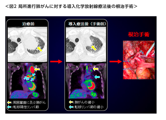 局所進行肺がんに対する導入化学放射線治療後の根治手術