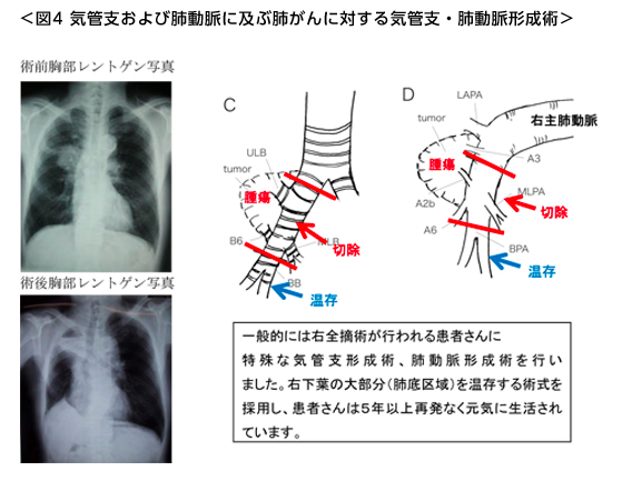 気管支および肺動脈に及ぶ肺がんに対する気管支・肺動脈形成術