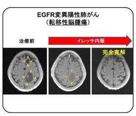 イレッサはEGFR変異陽性肺がんの予後を延長