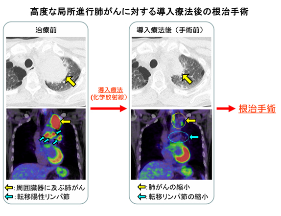 高度な局所進行肺がんに対する導入医療後の根治手術