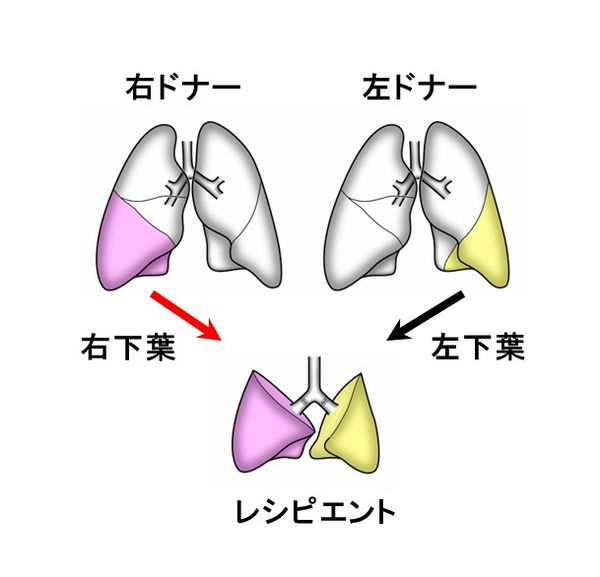 生体肺移植の図