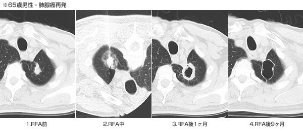 65歳男性・肺腺癌再発