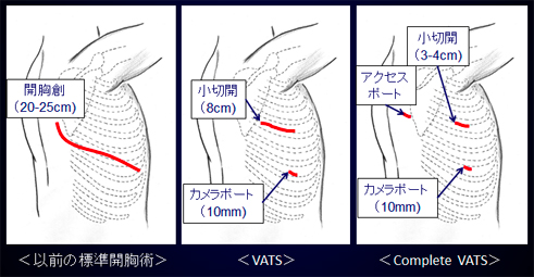 胸腔鏡補助下手術