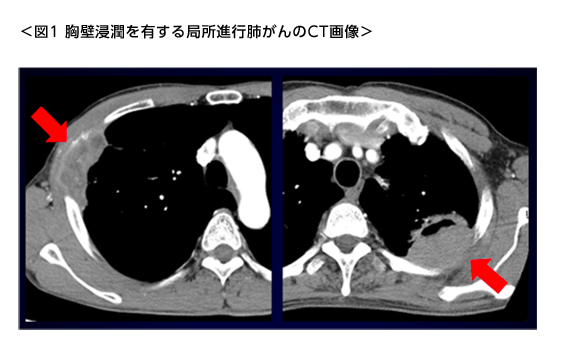 胸壁浸潤を有する局所進行肺がんのCT画像