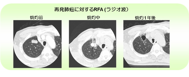 再発肺がんに対するRFA（ラジオ波）